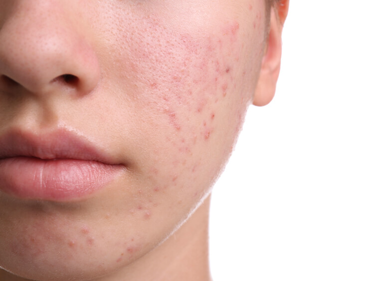 Acne Quiz Clinikally